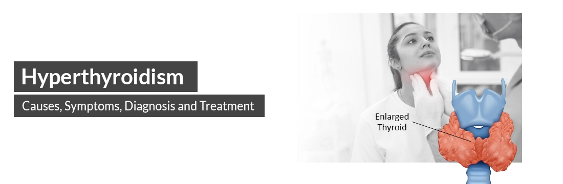 Hyperthyroidism: Causes, Symptoms, Diagnosis and Treatment